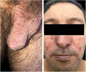 Scrotal ulcers and acne-like lesions on the malar regions.