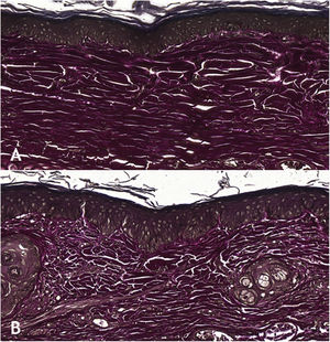 (A), Wound treated with 0.1% tacrolimus, showing strong staining and organized elastic fibers (Verhoeff, ×20). (B), Control wound showing weak staining and disorganized elastic fibers (Verhoeff, ×20).