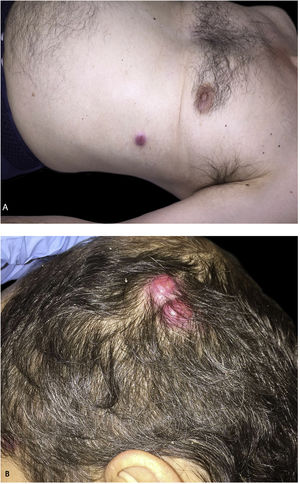 Multiple erythemato-violaceous nodules on the trunk (A) and the scalp (B).