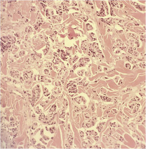 Medium-sized tumor cells arranged in nests (Hematoxylin & eosin, ×400).