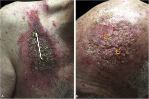 (A), Vegetative, hyperkeratotic, eroded plaques on the right chest (Mohs surgery site). The site of primary closure has been superimposed with a white line. (B), Left temple/forehead (cryosurgery site). Sites of original trauma have been superimposed with orange circles.