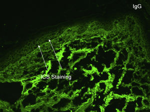 Direct immunofluorescence on skin biospy demonstrating IgG fluorescence around keratinocytes (white arrows).