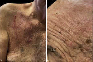 Complete healing 3 weeks after initiation of immunosuppressive therapy with residual erythema. A linear scar in the middle of the right chest can now be seen in the center.