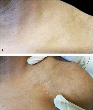 Zirelí propaedeutic maneuver in a pityriasis versicolor lesion on the left shoulder: (A) at rest; (B) after stretching (Zirelí sign), causing furfuraceous scales to detach and making the lesions evident.