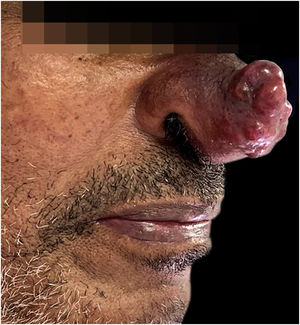 Exophytic, painful and intensely vascularized tumor on the nasal tip.