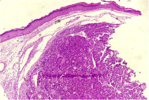 Dermis infiltrated by neoplastic cells arranged in an organoid pattern (Hematoxylin & eosin, ×4).