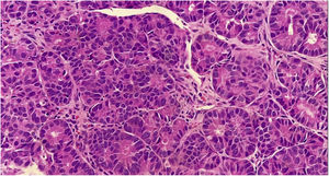 Cells with rounded, hyperchromatic nuclei, eosinophilic cytoplasm, arranged in an organoid pattern (Hematoxylin & eosin, ×40).