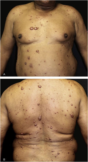 Multiple papules and nodular lesions diffusely distributed on the trunk.