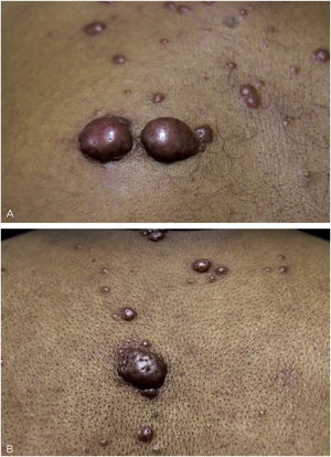 (A), Keloidiform nodular lesions, with smooth surface and an erythematous-brownish color, with evident vessels. (B), Papulonodular lesion with umbilications and satellite umbilicated papules.