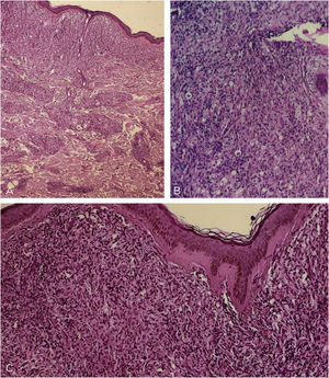 Light microscopy - (A), at low power one sees a Grenz zone; and a lymphohistiocytic infiltrate throughout the dermis, interspersed with collagen fibers (Hematoxylin & eosin, ×40). (B), Vacuolized clear-cytoplasm histiocytes, along with lymphocytic infiltrate (Hematoxylin & eosin, ×200). (C), Detail of the Grenz zone; multiple histiocytes, some of them spindle-shaped in a storiform pattern (multidirectional) (Hematoxylin & eosin, ×100).