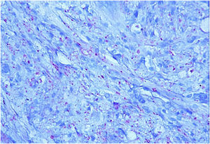 Several bacilli stained with fuchsin, acquiring a pinkish-red color. They are isolated and grouped. (Ziehl-Neelsen, ×40).