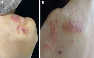 (A), Ulcerated lesion, with raised edges and an erythematous and hemorrhagic fundus. Purpuric lesions secondary to trauma; (B), Erythematous papular plaques on the scapula.