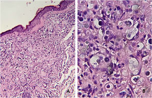 (A), Granulomatous dermal infiltrate consisting of lymphocytes, histiocytes, multinucleated giant cells and rounded structures, isolated or grouped, of different sizes, inside histiocytes and giant cells (Hematoxylin & eosin, ×100); (B), Greater detail of sporangia, hematoxylin-eosin staining (Hematoxylin & eosin, ×400).