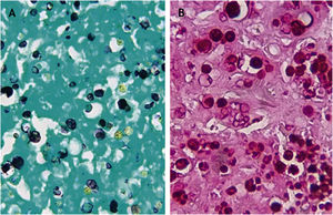 (A), Sporangia highlighted in black with silver staining (Grocott, ×400); (B), Sporangia highlighted by PAS staining (PAS, ×400).