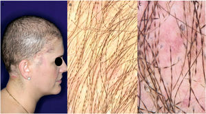 Thirty-four-year-old woman. (A), Clinical aspect. (B), Trichoscopy (macroscopic aspect). (C), Trichoscopy (×70 magnification).