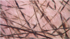 Trichoscopy with regular variations in the diameter of the hair shaft, with elliptical dilations and constrictions (×70 magnification).