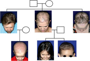 Heredogram of the reported family.