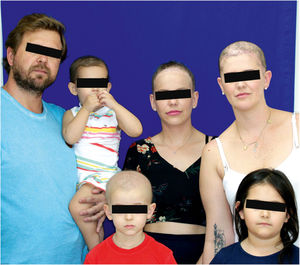 Variability of the clinical expression of monilethrix in the affected family members.