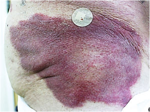 Erythematous infiltrated, well-delimited plaque, with a slightly scaling edge on the right side of the hip.
