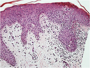 Histopathology: Epidermis with acanthosis and spongiosis mainly affecting the acrosyringial ducts and a mild superficial perivascular inflammatory infiltrate in the dermis (Hematoxylin & eosin, ×200).