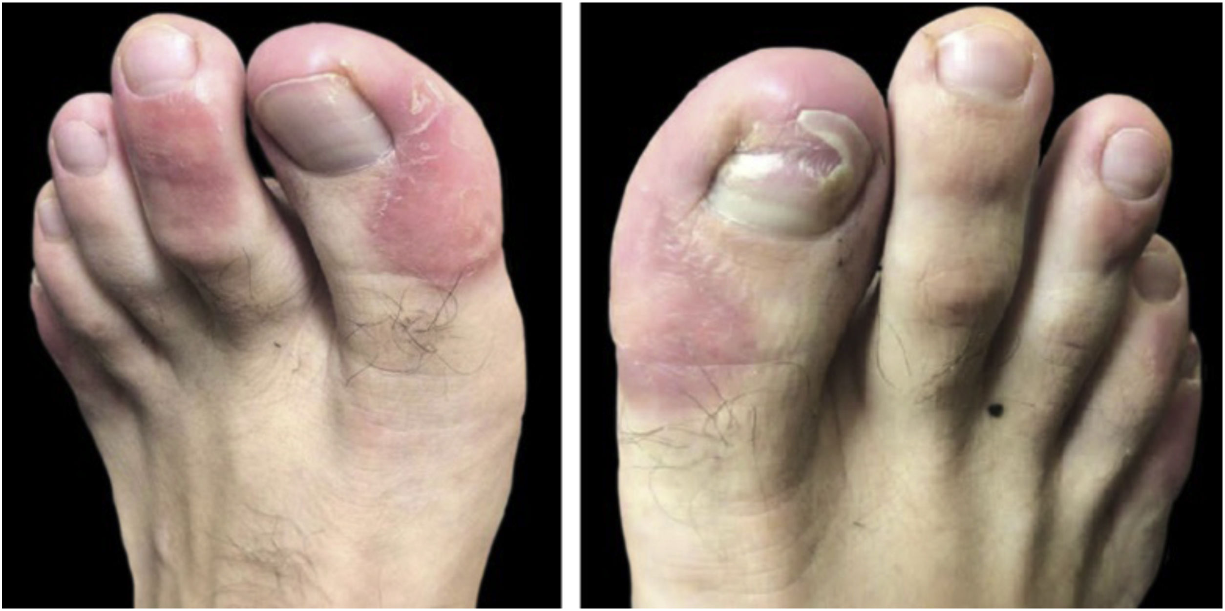 Foot Notes: A Comprehensive, Annotated, and Partially Illustrated Table of  Conditions in, under, and around Toe and Finger Nails - Gibbs - 1979 - The  Journal of Dermatologic Surgery and Oncology - Wiley Online Library