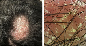 Erythematous-scaling alopecia plaque on the vertex region, measuring approximately 5 cm in its largest diameter. Dermoscopy showed erythema and follicular and interfollicular desquamation, suggesting an eczema pattern.