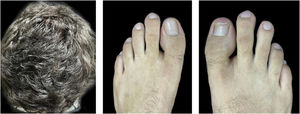 Ten months after the onset of the condition, with complete hair regrowth and remission of erythematous-scaling lesions on toes and onychodystrophy undergoing resolution on the right hallux.
