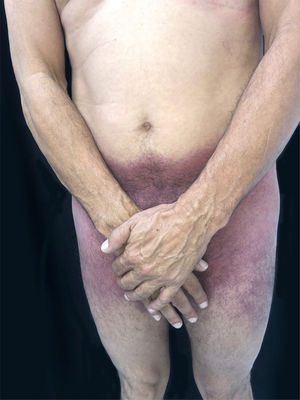 SDRIFE: erythematous-purpuric macules affecting the suprapubic region, lateral thighs and inguino-crural region.
