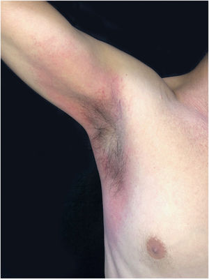SDRIFE: evidence of axillary involvement.