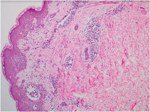SDRIFE: Histopathology showing perivascular lymphohistiocytic infiltrate in the superficial and mid-dermis (Hematoxylin & eosin, ×100).