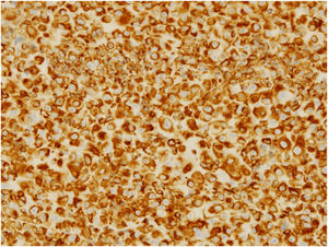 Strong immunopositivity for vimentin (Vimentin, ×400).