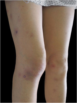 Erythematous subcutaneous nodules in thighs and legs.