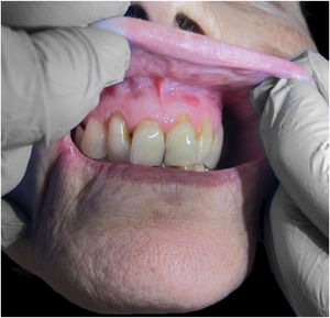 Oral ulcers.