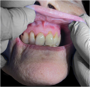 Oral ulcers.
