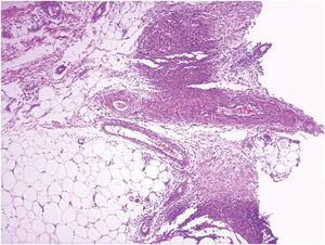 Neutrophilic inflammatory infiltrate in the hypodermis and vascular wall, (Hematoxylin & eosin, ×40).