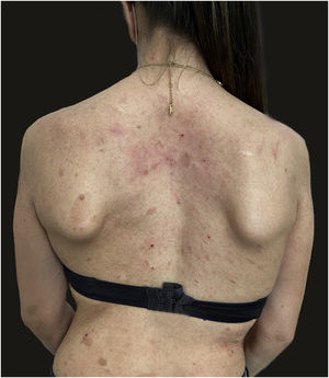 Remission of atopic dermatitis after 4 weeks of treatment with dupilumab. Residual eczematous lesions, as seen on the neck, determined an EASI score of 4.