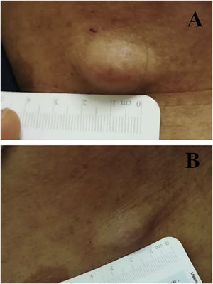 (A), Cutaneous neurofibroma before starting treatment with dupilumab. (B), The same lesion shows evident reduction in swelling and firmness after four weeks of therapy.