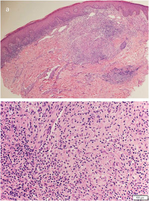(A), Granulomatous infiltration in upper and mid-dermis. (B), Non-caseating epithelioid cell granuloma with peripheral lymphocytic rim.