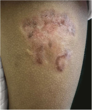 Scar at site of lesion post-treatment.