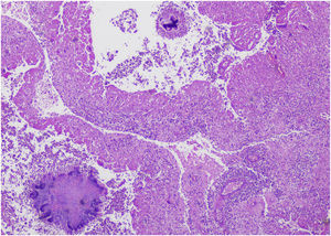 Histopathology showing two different types of colonies (Hematoxylin & eosin, ×10).