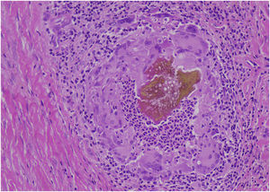 Septate fungal hyphae with hyaline budding surrounded by multinucleated giant cells, neutrophils, eosinophils, and lymphocytes (Hematoxylin & eosin, ×40).