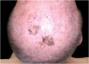 Residual pigmentary lesion after surgery.