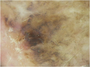 Some dermoscopic features of the lentigo maligna-melanoma in situ.