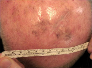 50% resolution of the lentigo maligna after 4 months of 5% Imiquimod.