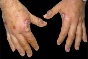 Clinical presentation. Eythematous-violaceous plaques, pustules, and bullous lesions on the dorsal hands.
