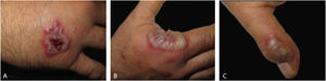 Detail of individual lesions of neutrophilic dermatosis of the dorsal hands (A), Crusted violaceous plaque (B), Large blister with an erythematous base on the radial aspect of the right hand (C), A lesion with purulent discharge over interphalangeal joint of the left hand.