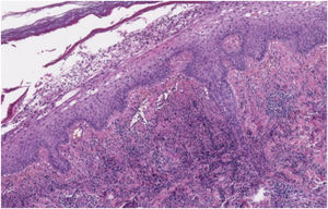 At low power, epidermis is acanthotic and there is subcorneal purulent material. A dense neutrophilic infiltrate is present in the upper dermis (Hematoxylin & eosin, ×8).