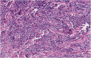 A high-magnification image showing a heavy dermal infiltrate of neutrophils (Hematoxylin & eosin, ×20).