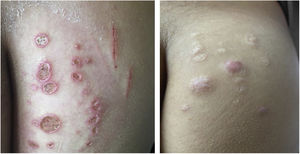 Non-tuberculous cutaneous mycobacteriosis caused by Mycobacterium chelonae in a child diagnosed by culture in Löwenstein-Jensen medium (identification by partial genetic sequencing of the rpoB gene). Treatment with monotherapy using clarithromycin resulted in complete cure.