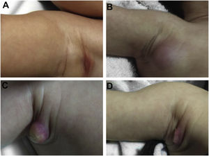 Adverse reaction to Bacillus Calmette-Guérin (BCG) vaccination. (A), Three months after the vaccination, showing regional axillary adenomegaly. (B), Four months after the vaccination with increased lymph node enlargement. (C), Five months after the vaccination with abscess formation. (D), Six months after the vaccination, with suppurative lesion.